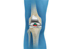 ACL Preserving Total Knee Replacement