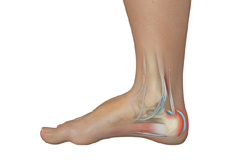 Achilles Tendon Bursitis