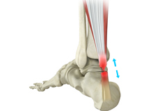 Achilles Tendon Rupture