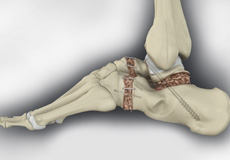 Ankle Arthrodesis