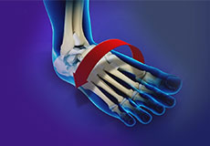 Ankle Instability Surgery