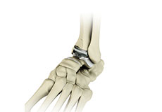 Ankle Joint Replacement