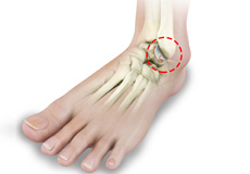 Ankle Rheumatoid Arthritis