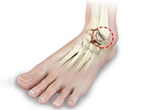 Foot and Ankle Arthritis