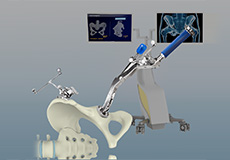 Computer-assisted Hip Replacement