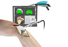 Computer Navigation for Total Knee Replacement