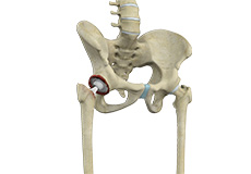 Correction of a Failed Hip Replacement