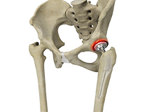 Correction of a Painful Hip Replacement