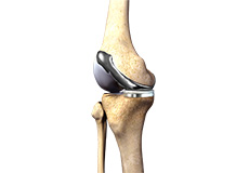 Custom-fitted Total Knee Arthroplasty