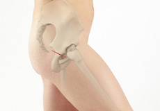 Direct Superior Hip Replacement