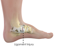 Ankle Ligament Injury