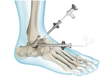 Foot Reconstruction