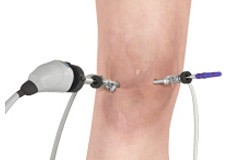 Knee Arthoscopy