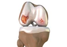 Knee Osteoarthritis