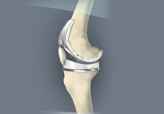 Patient Specific Knee Replacement