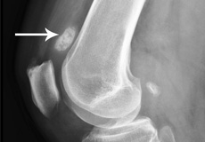 Correction of a Loose Knee Replacement