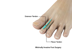 Minimally Invasive Foot Surgery