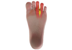 Morton's Neuroma