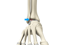 Osteochondral Injuries of the Ankle