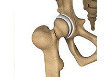 Outpatient Anterior Approach Hip Replacement