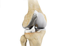 Partial Lateral Knee Replacement