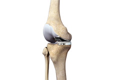 Painful or Failed Total Knee Replacement