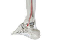 Posterior Tibial Tendon Dysfunction