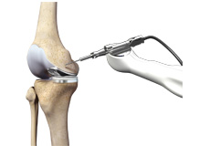 Robotic Assisted Partial Knee Surgery