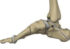 Subtalar Arthrodesis