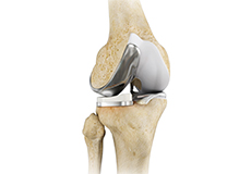 Unicompartmental/Partial Knee Replacement